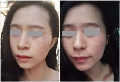斑专业榜单祛斑效果最好的第一OG真人2024十大内推淡(图3)