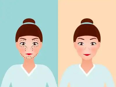 目比较好？几天见效术后案例医院OG真人想要眼部提升做什么项(图2)